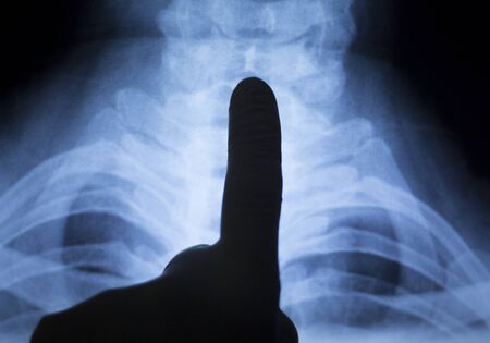 Spinal column, vertebra, neck and back medical x-ray test scan result for adult showing orthopedic...