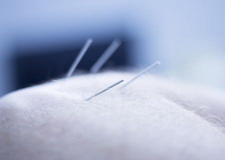 Dry needling acupunture needles used by acupunturist physiotherapist on patient in pain and injury treatment closeup macro hoto.の写真素材