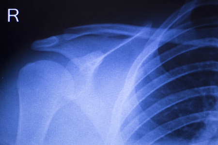 Shoulder joint injury xray traumatology and orthopedics test medical scan used to diagnose sports injuries in patient.の写真素材