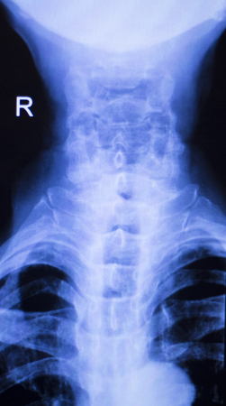 Neck and spine xray traumatology and orthopedics spinal vertebra test medical scan used to diagnose...