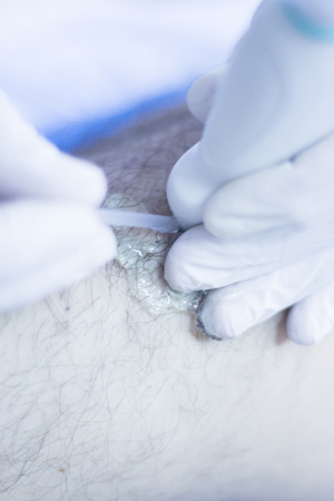 Dry needling acupunture therapy with acupunturist physiotherapist in hospital clinic.の写真素材