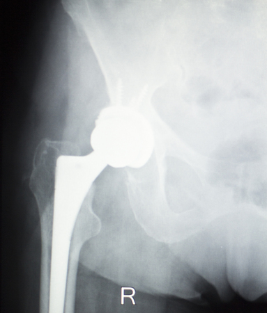Hip joint replacement orthopedic titanium metal Traaumatology ball and socket implant x-ray image of old aged patient.の写真素材