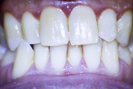 Dentists dental tooth photograph showing tooth non aligned front teeth and plaque.の写真素材