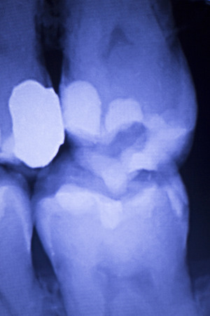 Dentists dental teeth x-ray showing tooth fillings image.の写真素材