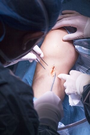 Surgical operation for knee arthroscopy micro surgery in hospital operating theater emergency room of traumatology and orthopedics.の写真素材