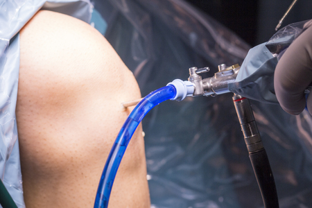 Surgical operation for knee arthroscopy micro surgery in hospital operating theater emergency room of traumatology and orthopedics.の写真素材