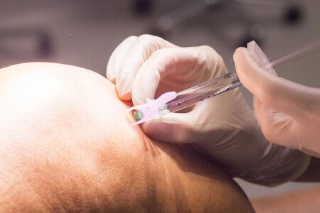 Anaesthetist anaestthetic injection for surgical operation knee arthroscopy micro surgery in hospital operating theater emergency room.の写真素材