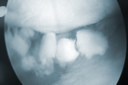 Arthroscopy surgery screen showing arthroscope camera picture in knee meniscus surgical operation to repair injury closeup.の写真素材