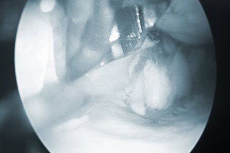 Arthroscopy surgery screen showing arthroscope camera picture in knee meniscus surgical operation to repair injury closeup.の写真素材