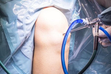 Surgical operation for knee arthroscopy micro surgery in hospital operating theater emergency room...
