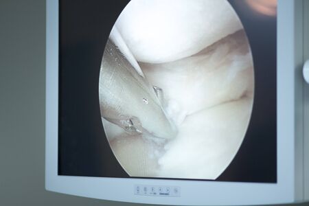 Arthroscopy surgery screen showing arthroscope camera picture in knee meniscus surgical operation to repair injuryの写真素材