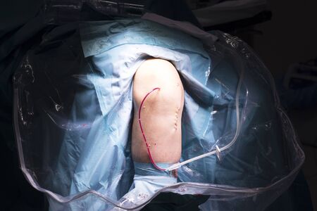 Surgical operation knee arthroscopy micro surgery in hospital operating theater emergency room for traumatology and orthopedics.の写真素材