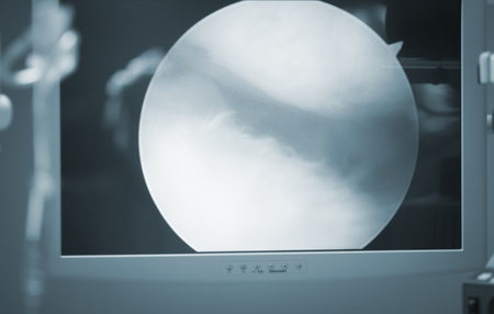 Arthroscopy surgery screen showing arthroscope camera picture in knee meniscus surgical operation to repair injuryの写真素材