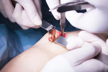 Surgical operation knee arthroscopy micro surgery on knee, tendon, ligament and meniscus  in hospital operating theater emergency room.の写真素材