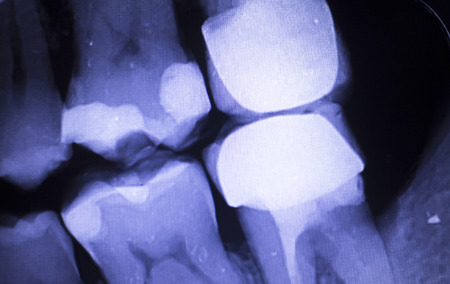 Tooth with filling dental x-ray close-up image showing teeth roots, gum disease and tooth decay to...