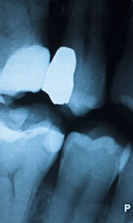 Tooth with filling dental x-ray close-up image showing teeth roots, gum disease and tooth decay to...