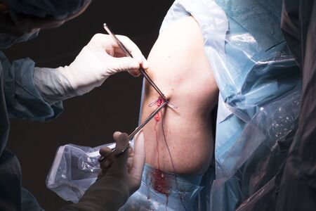 Surgical operation knee arthroscopy micro surgery in hospital operating theater emergency room for...