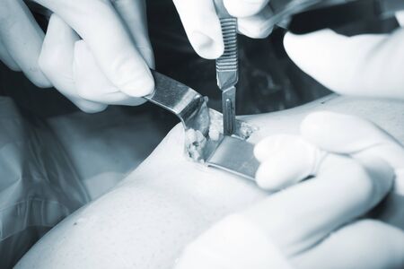 Surgical operation knee arthroscopy micro surgery on knee, tendon, ligament and meniscus  in hospital operating theater emergency room.の写真素材