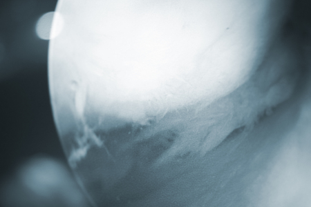 Arthroscopy surgery screen showing arthroscope camera picture in knee meniscus surgical operation to repair injury closeup.の写真素材