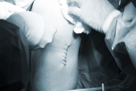Surgical operation knee arthroscopy micro surgery in hospital operating theatre emergency room for traumatology and orthopedics.の写真素材