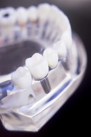 Dentists tooth plastic model used for teaching, learning and patient consultations in dental office showing teeth and gums.の写真素材