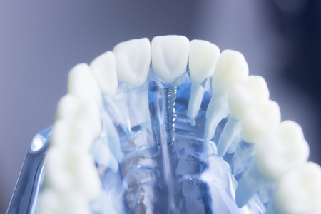 Dental tooth dentistry student learning teaching model showing teeth, roots, gums, gum disease, tooth decay and plaque.の写真素材