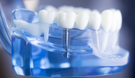 Dental tooth dentistry student learning teaching model showing teeth, roots, gums, gum disease,...