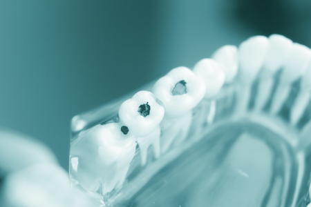Dental tooth dentistry student learning teaching model showing teeth, roots, gums, gum disease, tooth decay and plaque.の写真素材