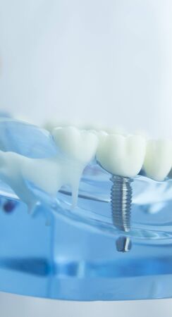 Dental tooth dentistry student learning teaching model showing teeth, roots, gums, gum disease, tooth decay and plaque.の写真素材