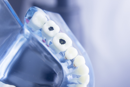 Dental tooth dentistry student learning teaching model showing teeth, roots, gums, gum disease, tooth decay and plaque.の写真素材