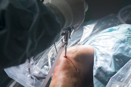 Knee keyhole surgery hospital arthroscopy operation medical procedure in emergency room operating theater.の写真素材