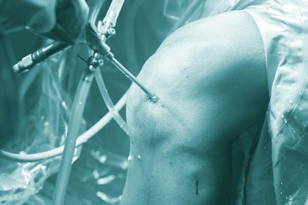 Knee keyhole surgery hospital arthroscopy operation medical procedure in emergency room operating theater.の写真素材