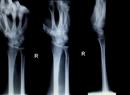 Orthopedics Hand finger joint meniscus, ligament, tendon and cartilage injury X-ray scan.の写真素材