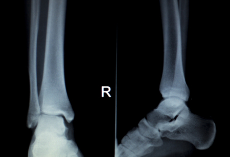 Xray foot heel ankle test scan results showing orthopedic titanium metal implant screws after injury surgical operation.の写真素材