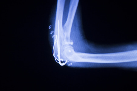 Elbow joint titanium metal modern implant x-ray test scan result after traumatology and orthopedics surgery.の写真素材