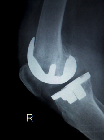 Orthopedics knee joint meniscus, ligament, tendon and cartilage injury titanium modern metal implant...