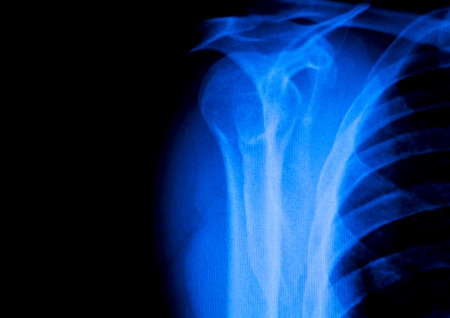 Shoulder back ribs orthopedics Xray test scan result used by Traumatologist to diagnose inury and treatment required.の写真素材