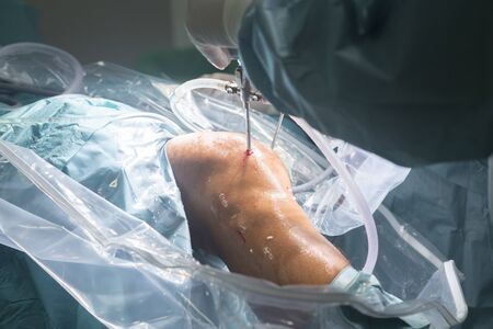 Knee keyhole surgery hospital arthroscopy operation medical procedure in emergency room operating theater.の写真素材