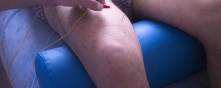 Physical therapy mecical clinic physiotherapy EPI acupunture dry needling treatment for leg injury rehabilitation.の写真素材