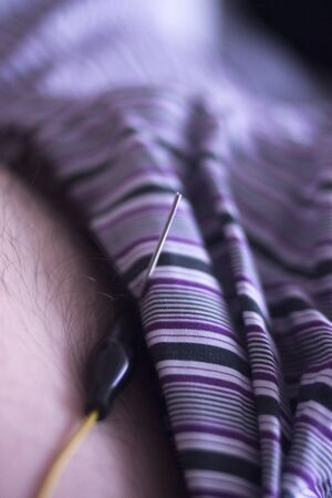 Physical therapy mecical clinic physiotherapy EPI acupunture dry needling treatment for leg injury rehabilitation.の写真素材