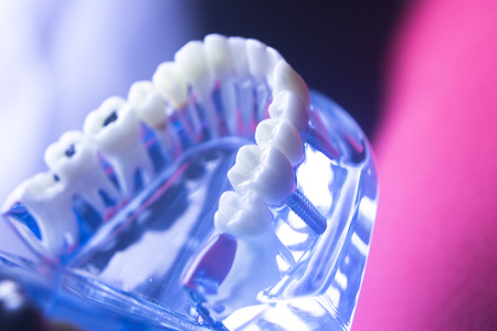 Dentists' dental teeth model showing tooth enamel, gums, roots, plaque, decay, and titanium metal implants.の写真素材