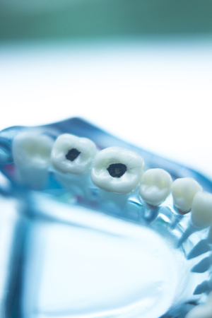 Dentists dental teeth teaching model showing each tooth, gum, root, implant, decay, plaque and enamel.の写真素材