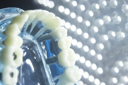 Dentists dental teeth teaching model showing each tooth, gum, root, implant, decay, plaque and...