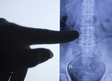 Back spine vertabrae xray test scan results of  patient with arthritis and joints pain.の写真素材