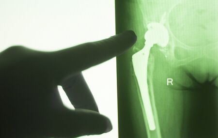 Hip joint replacement impant x-ray test scan results of old aged person with arthritis and joints pain.の写真素材