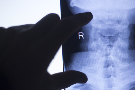Back spine vertabrae xray test scan results of  patient with arthritis and joints pain.の写真素材