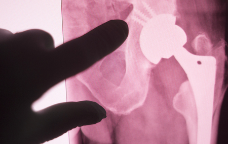 Hip joint replacement impant x-ray test scan results of old aged person with arthritis and joints pain.の写真素材