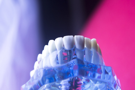 Dentists' dental teeth model showing tooth enamel, gums, roots, plaque, decay, and titanium metal implants.の写真素材