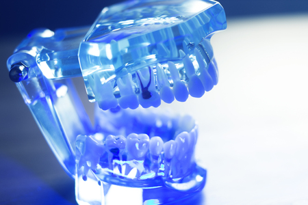 Dental teeth orthodontic dentistry teachng model with gums, tooth enamel, plaque, roots and metal implants.の写真素材