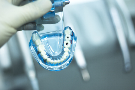 Dental teeth orthodontic dentistry teachng model with gums, tooth enamel, plaque, roots and metal...